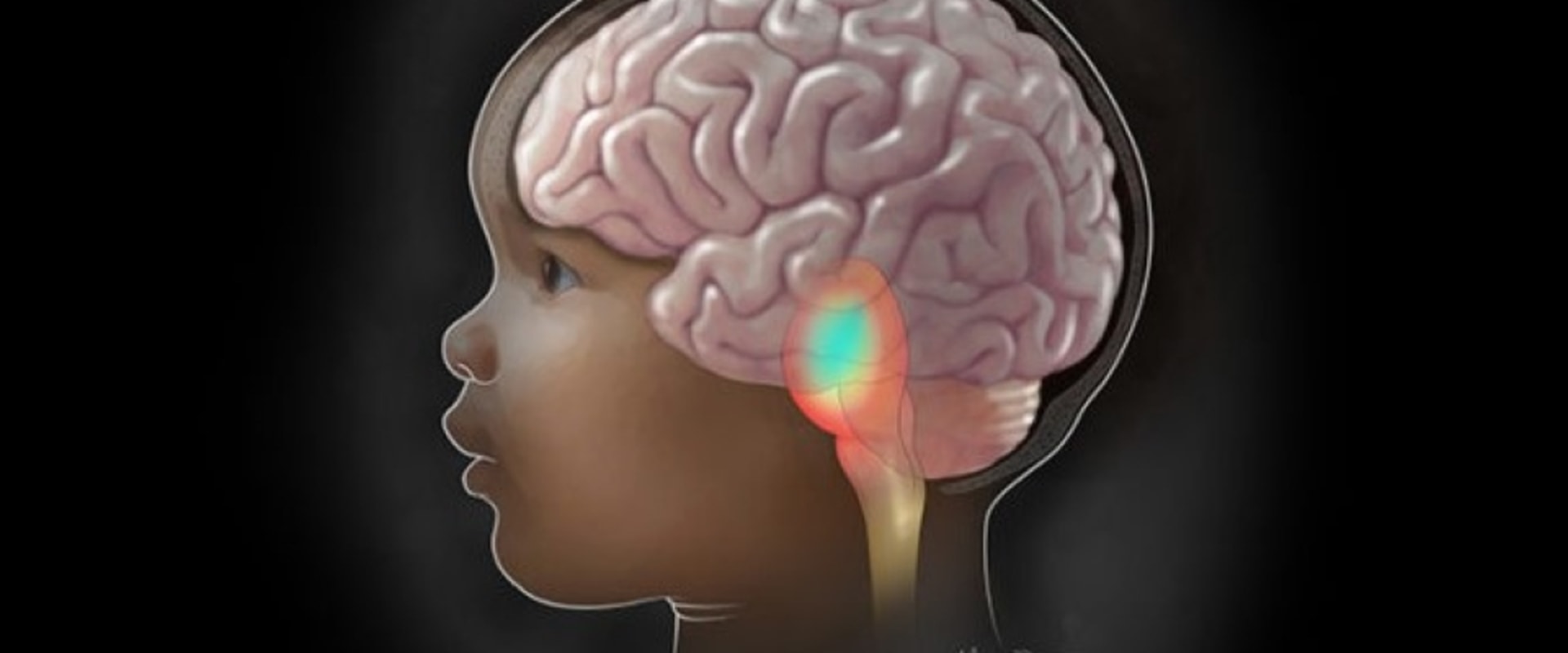 Understanding Brain Tumors in Children
