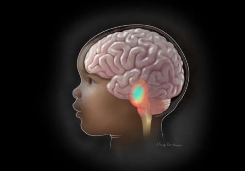 Understanding Brain Tumors in Children