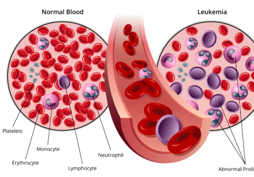 Understanding Leukemia in Children: Insights and Advances